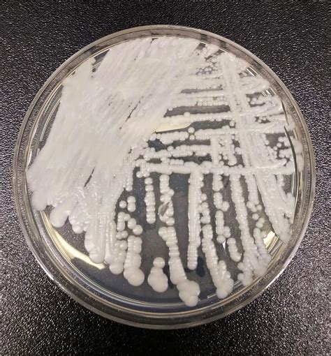 California, Nevada states with most superbug fungus infections